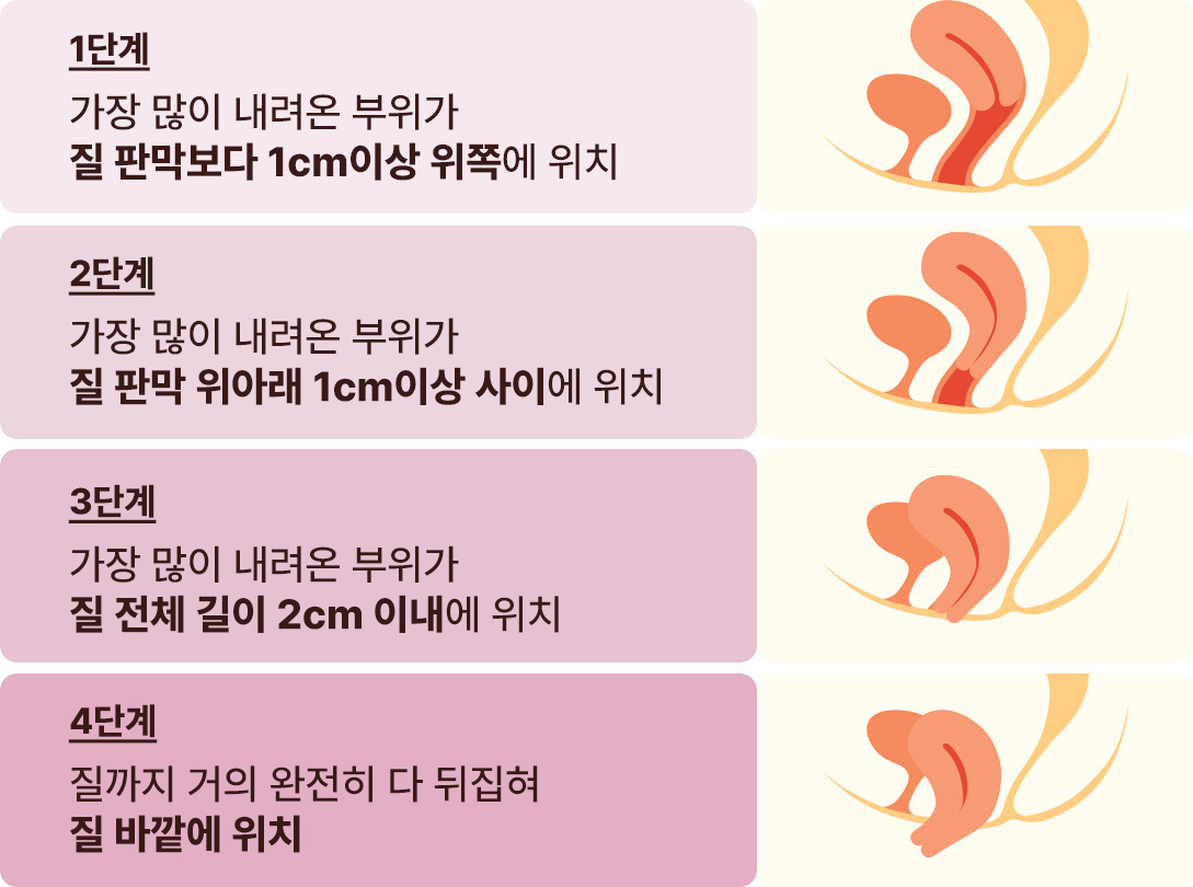 자궁탈출증 진행 단계