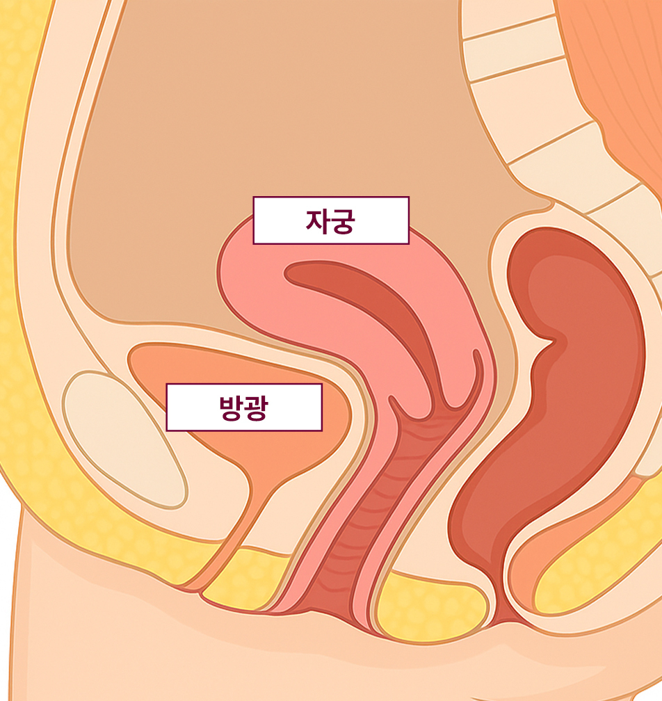 요실금